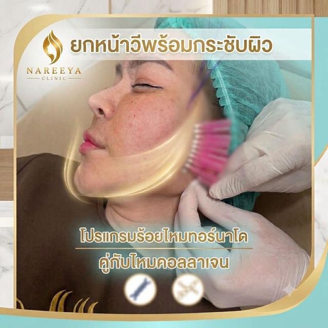 ร้อยไหมคอลลาเจน หน้ากระชับ หน้าเฟิม