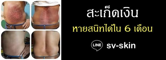 ปวดหัวไมเกรนเรื้อรัง รักษาที่ต้นเหตุอย่างได้ผลจริง สามารถหายสนิทได้ใน 1 เดือน LINE: sv-skin รูปที่ 2