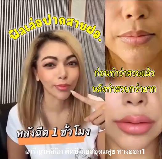 ฟิลเลอร์ปาก