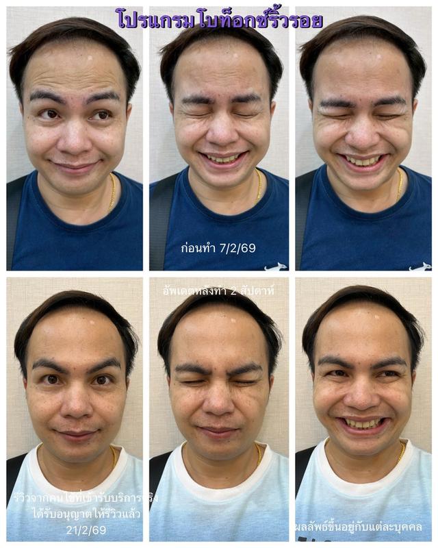 โบท็อกซ์ริ้วรอย 8 จุด