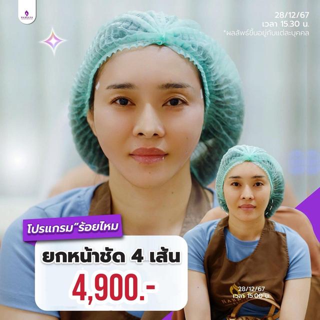 ร้อยไหมกรอบหน้า