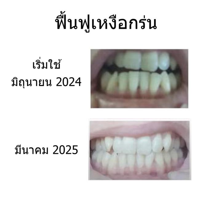 #เหงือกร่นฟันโยกคลอน #ปริทันต์อักเสบ #รำมะนาด ปรีกษาฟรี