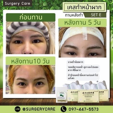 รีวิวพลีชีพ! พลังสมุนไพรจีนกู้หน้าหลังศัลยกรรม บวมช้ำแค่ไหนก็เอาอยู่ รูปย่อยที่ 3