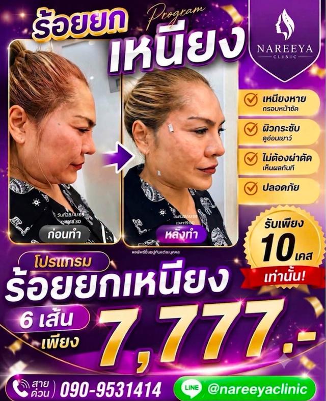 ร้อยไหมยกหน้า ยกเหนียง เลือกได้ค่ะ