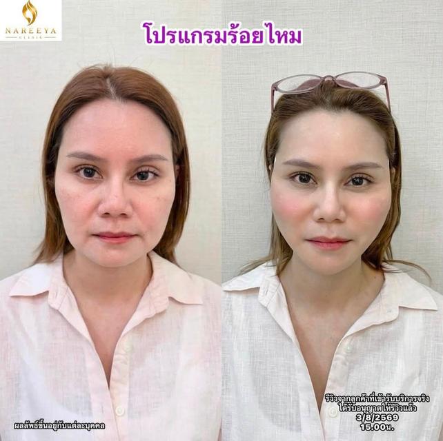 โปรแกรมร้อยไหมยกกระชับ 8.8
