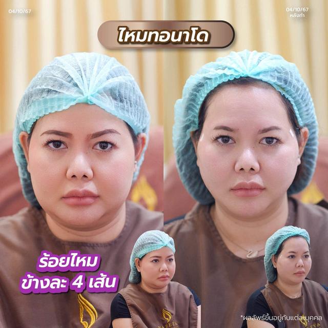 ร้อยไหมยกกระชับหน้าวีเชฟ