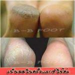 B-B FOOT ขายน้ำยาสปา&แก้ปัญหาส้นเท้าแตก เห็นผลใน 30 นาที