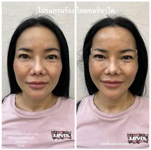 ร้อยไหมยกกระชับพรีเมี่ยม