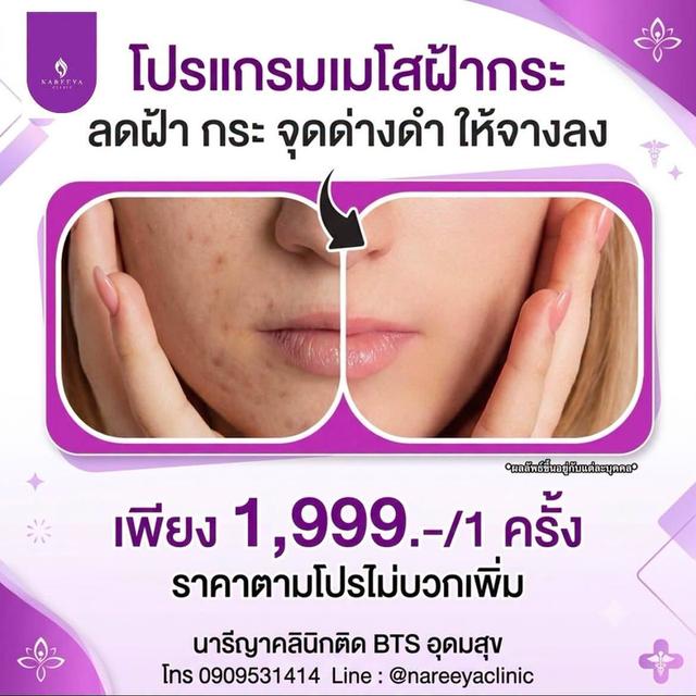 เมโสฝ้ากระ ลดรอยจุดด่างดำ ฝ้ากระจางลง