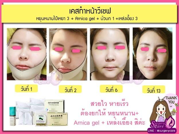 เหล่งเอี๊ยง EXTRA เร่งฟื้นตัว ผ่าตัดศัลยกรรมหายไว รูปย่อยที่ 3