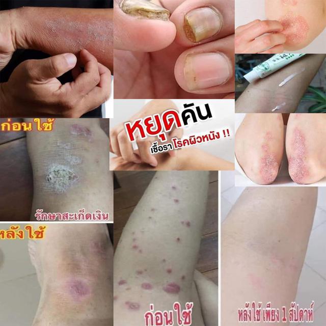รูป ยาทาแก้คันBKครีม 5