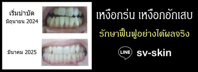 เหงือกร่นฟันโยกคลอน กลิ่นปากเหม็นเรื้อรัง ปริทันต์อักเสบ รำมะนาด เหงือกอักเสบเป็นหนอง รักษาฟื้นฟูอย่างได้ผลจริง LINE: sv-skin