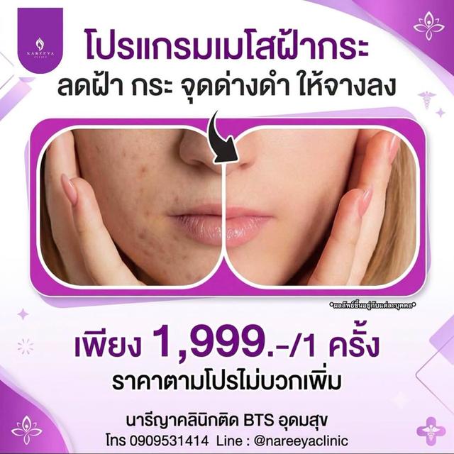 เมโสหน้าใส ลดเม็ดสี ผิวขาวอมชมพู