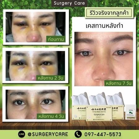 รีวิวพลีชีพ! พลังสมุนไพรจีนกู้หน้าหลังศัลยกรรม บวมช้ำแค่ไหนก็เอาอยู่ รูปย่อยที่ 2