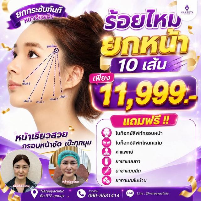 ร้อยไหมยกกระชับหน้าวีเชฟ