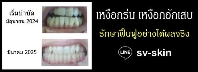 กลิ่นปากเหม็นเรื้อรัง ฟันผุ ปริทันต์อักเสบ รำมะนาด เหงือกร่นฟันโยกคลอน เหงือกอักเสบ รักษาฟื้นฟูอย่างได้ผลจริง LINE: sv-skin