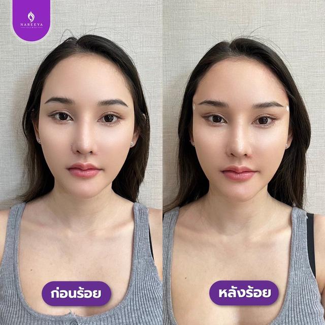 ร้อยไหมยกคิ้ว ยกหางตา